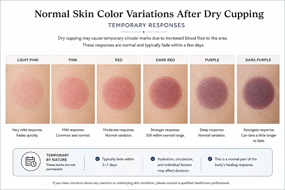 Cupping marks explained after cupping for muscle tension (cupping therapy benefits / acupuncture vs cupping)